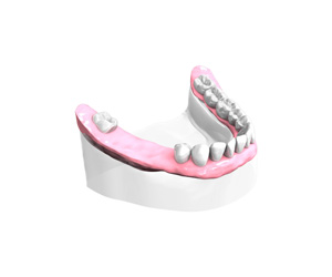 Remplacer plusieurs dents absentes ou abîmées - Dentiste Osny