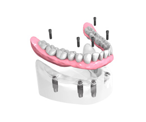 Remplacer toutes les dents absentes ou abîmées - Dentiste Osny