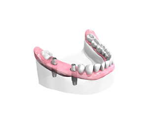 Remplacer plusieurs dents absentes ou abîmées - Dentiste Osny