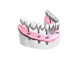 Remplacer toutes les dents absentes ou abîmées - Dentiste Osny